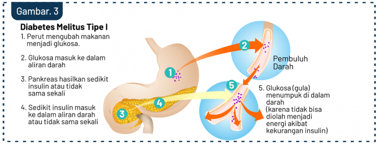 Ini Beda Diabetes Melitus Dm Tipe 1 And Tipe 2 –