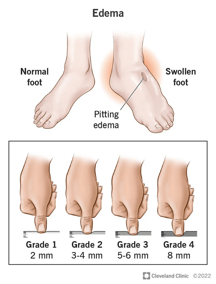 cara-menentukan-derajat-edema-gustinerz